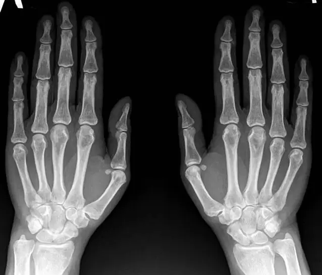 Artrite do pulso na radiografía antes de usar Hondroine