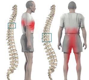 Dor na columna vertebral con osteocondrose torácica