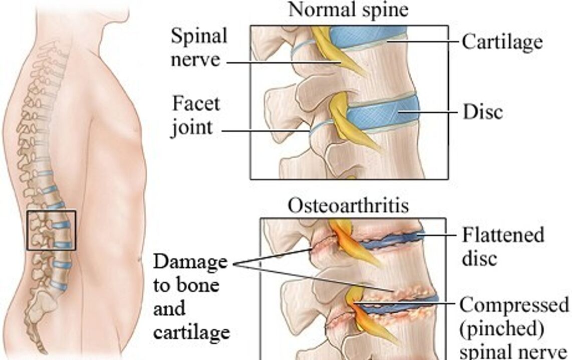 A diferenza entre un disco saudable e unha porción con osteocondrose